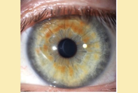 Irisdiagnostik 